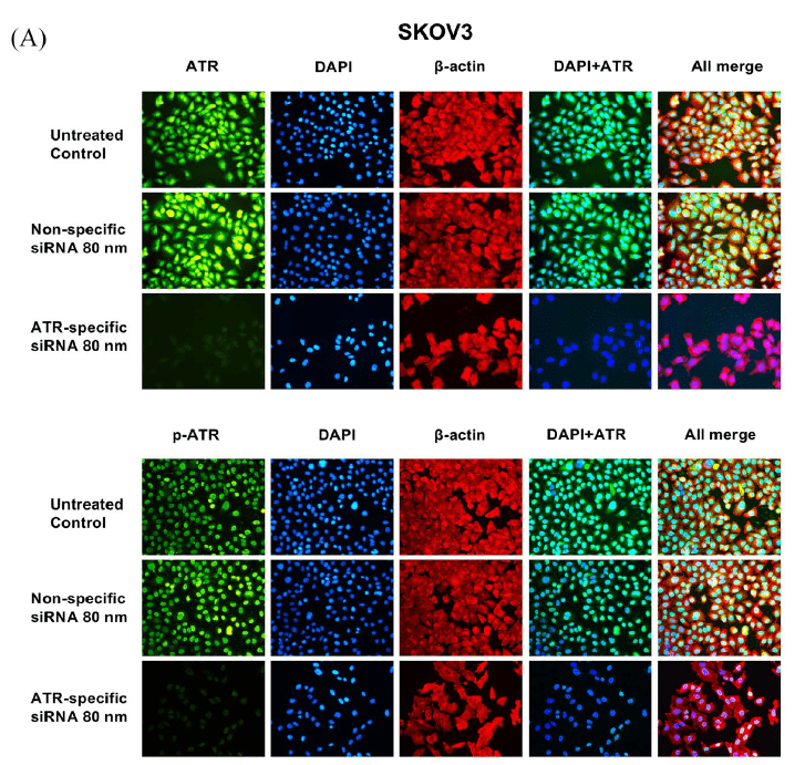 ATR And Phospho ATR Ser428 P ATR Expression In Ovarian Cancer